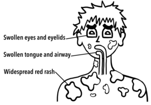Image demonstrating anaphylaxis