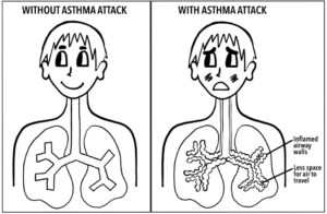 Image showing what happens in lungs during asthma attack