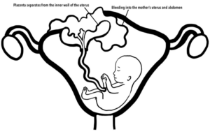 Diagram showing a placental abruption