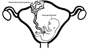 Diagram showing fetus in utero with placenta problems