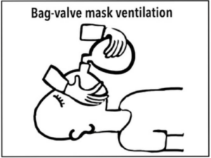 Image demonstarting bag valve ventilation