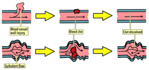 Diagram showing blood flow clots