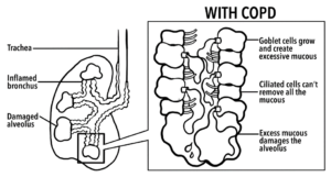 Image of lung and airway with COPD