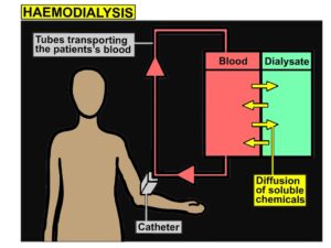 Illustration demonstrating haemodialysis