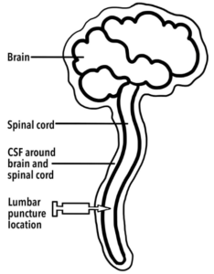 Diagram showing lumbar puncture