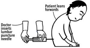 Diagram demonstrating lumbar puncture insertion
