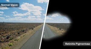 Image of the difference between vision with and without rentinitis pigmentosa