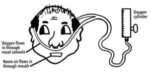 Image illustrating nasal cannula