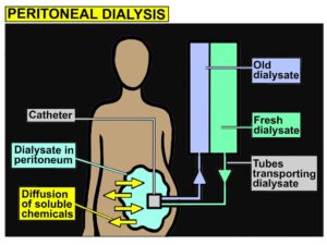 Illustration demenstrating peritoneal dialysis