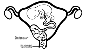 Diagram demonstrating placenta over cervix
