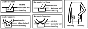 Image showing different types of stomas