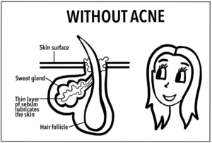 Image of unblocked hair follicle without acne