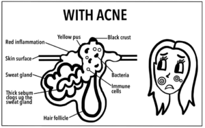 Image of blocked hair follicle with acne