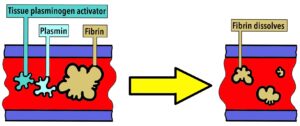 Diagram showing fibrin dissolving