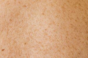 Image of human skin, white with dark spots