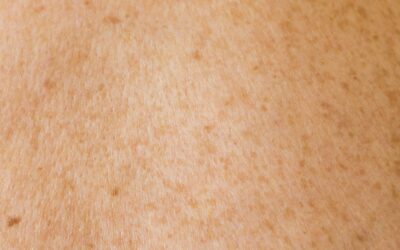 What is a skin graft?