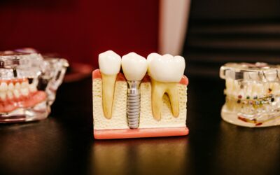 Root Canals