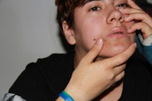 Image of someone with a spot