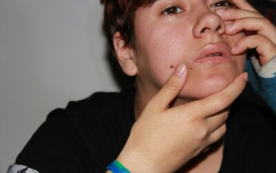 Can adults get zits? 
