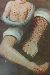 Small pox illustration